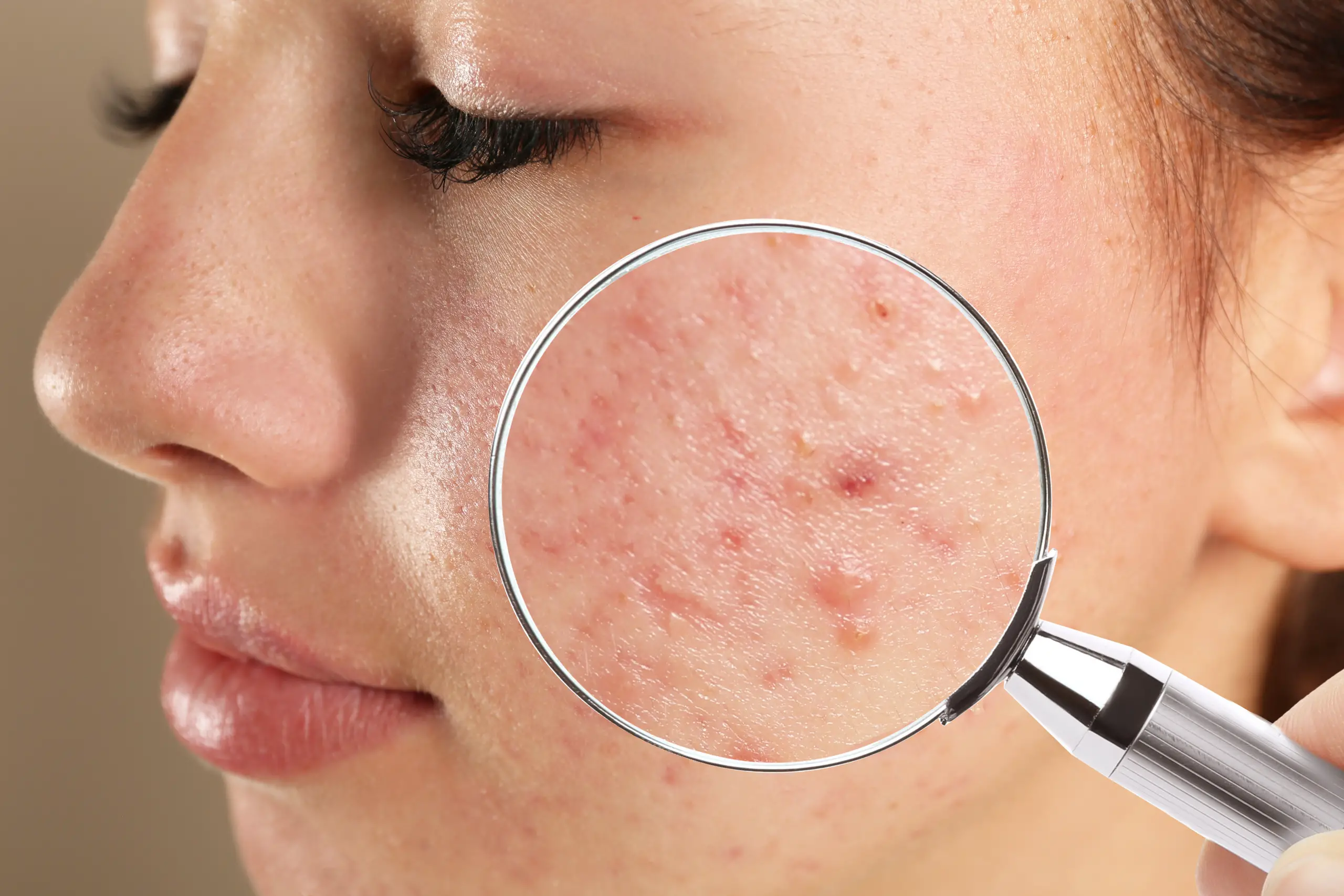 What Causes Facial Acne?
